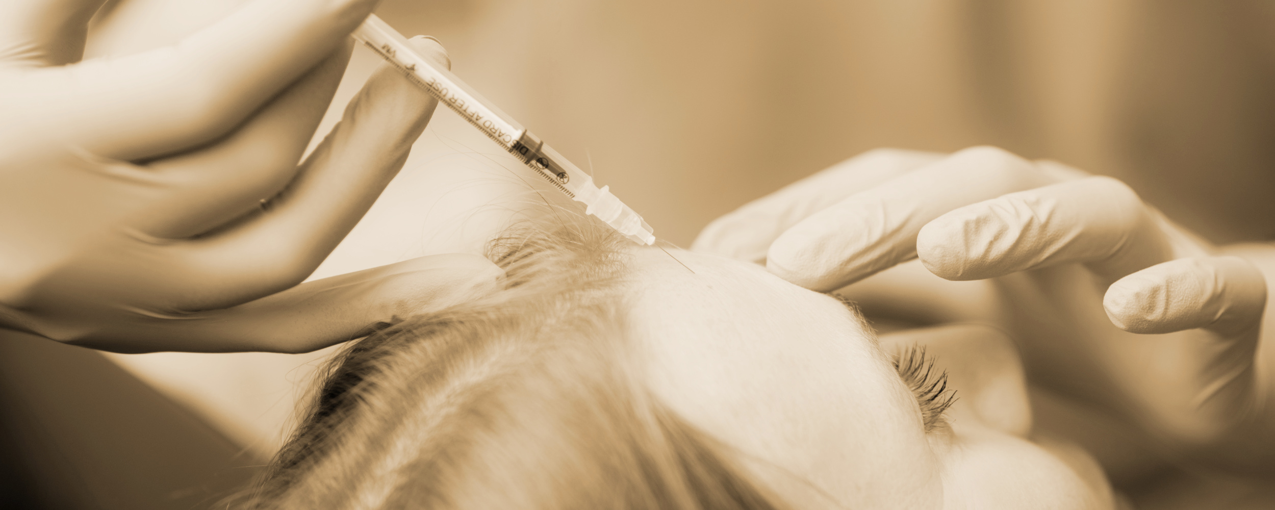 Unterspritzung an der Stirn einer Patientin in Sephiatönen