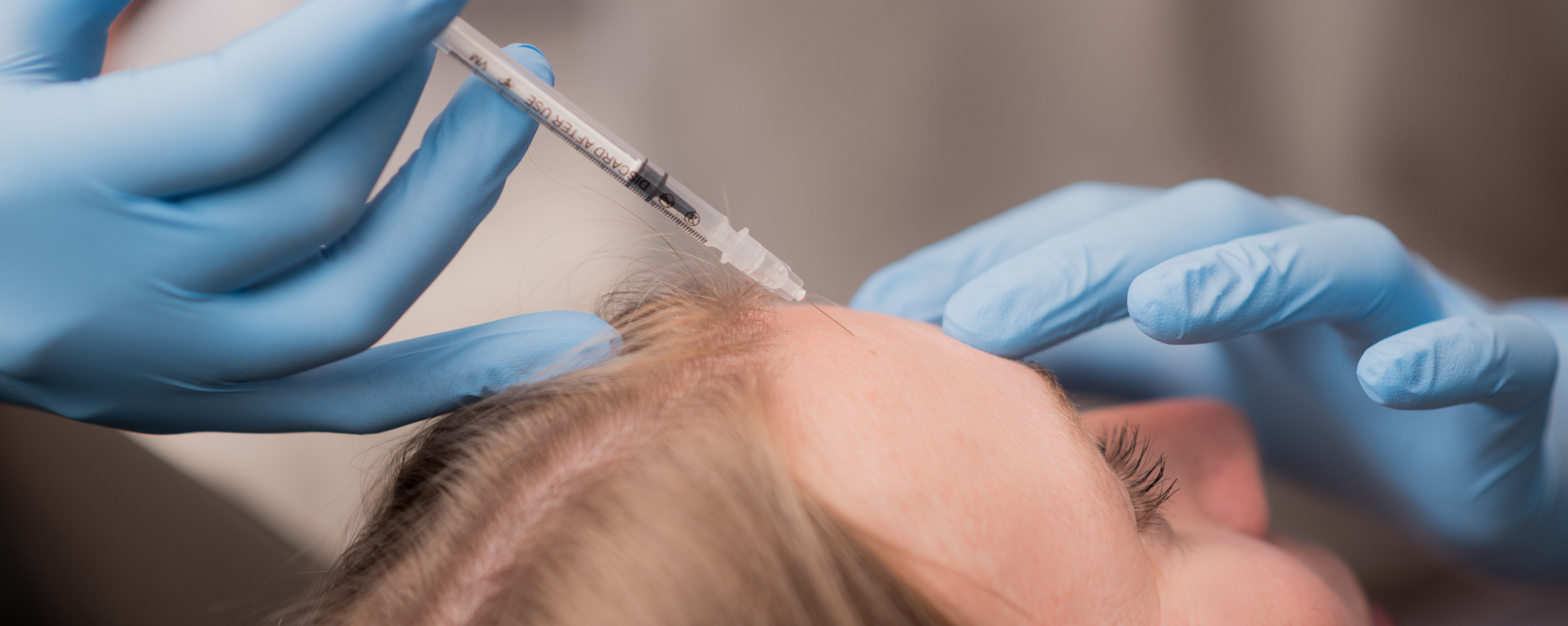 Unterspritzung an der Stirn einer Patientin